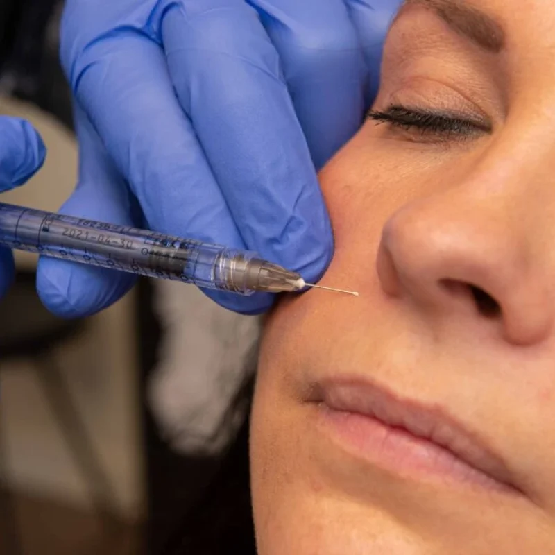 Lipfillers zetten in Limburg